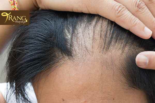 Rụng tóc nhiều ở nam là bệnh gì