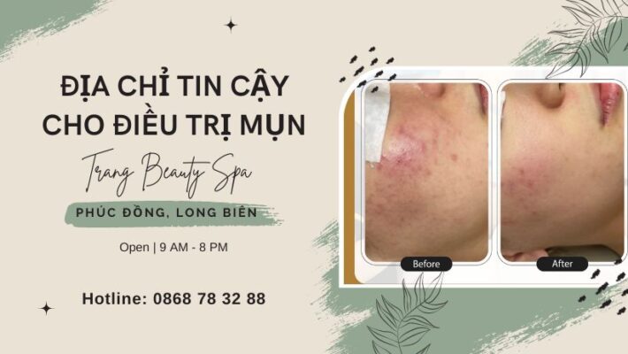 Trang Beauty Spa - Địa chỉ tin cậy cho điều trị mụn tại Phúc Đồng, Long Biên